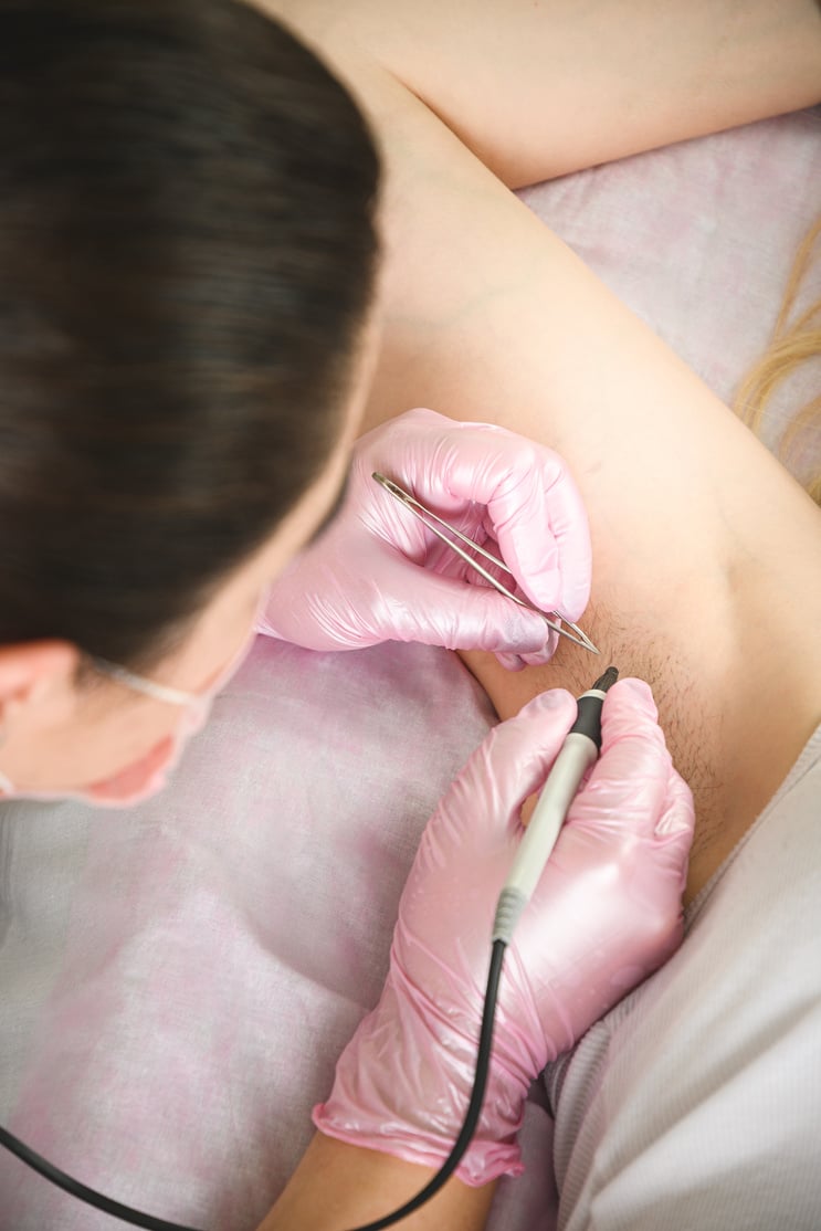 Removal of hair permanently in a woman's armpits using electrolysis.