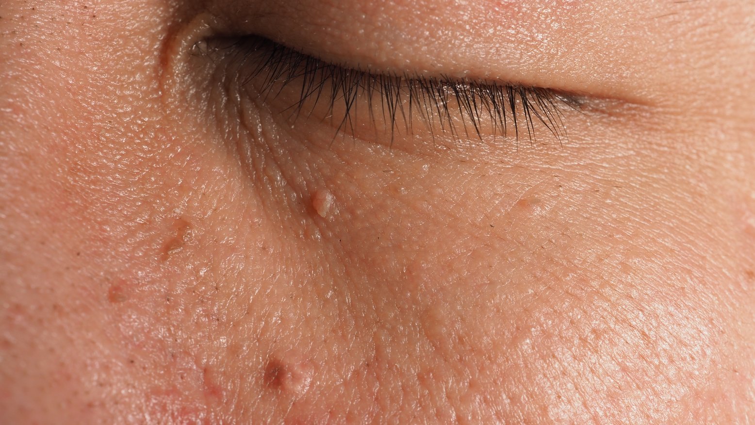 Wart on Face. Macro Shot of Wart near Eye. Papilloma on Skin.